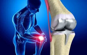 Arthroplastie du genou